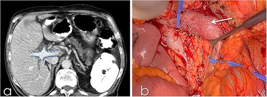 (a) CT with contrast demonstrating the trifurcated portal vein (arrow); (b) gross appearance of the duplicated IVC intraoperatively (arrow).