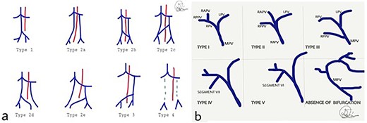 (a) Classification of IVC abnormalities; (b) variations of the branching of portal vein. MPV: main portal vein, RPV: right portal vein, LPV: left portal vein, RAPV: right anterior portal vein, RPPV; right posterior portal vein.