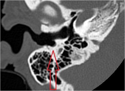 Axial cut in the inferior aspect of the external auditory canal in patient A (CT of the temporal bone) demonstrating the indentation of the inferior aspect of the external auditory canal.