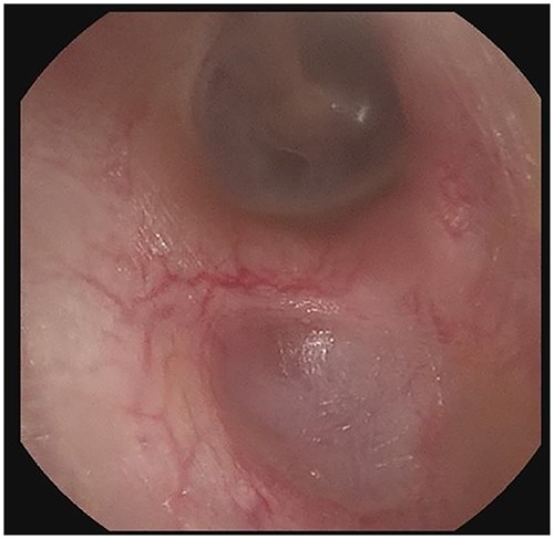 Right external auditory canal on patient A demonstrating excellent mucosalization of the indentation in the inferior aspect of the external auditory canal after serial cerumen debridement procedures in the office.