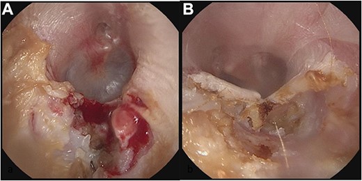 Panel a shows the indentation of the left external auditory canal with bony sequestration. Picture was after debridement. Panel b shows the right external auditory canal. Less extensive than the left, however, fragmentation and sequestration is also seen.