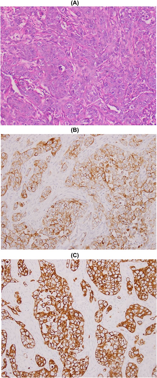 Metastasis of high-grade infiltrating urothelial carcinoma: poorly differentiated carcinomatous process (A), CK7+ (B) and CK20+ (C).