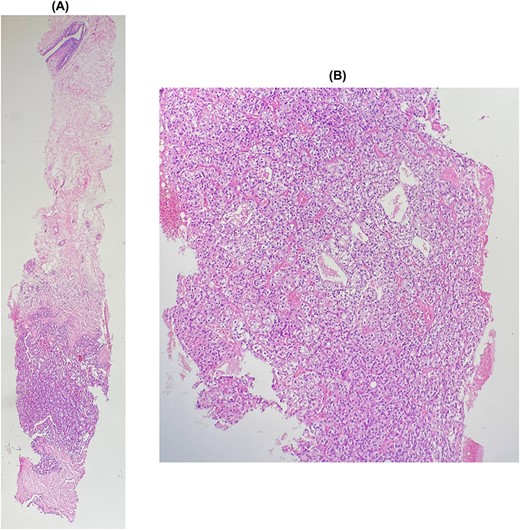 (A) and (B): Breast metastasis of clear cell carcinoma. Breast tissue infiltrated by a carcinomatous proliferation composed of nests, separated by a vascular network. Tumor cells show clear cytoplasm surrounded by distinct cell membranes.
