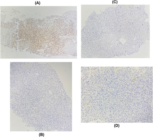 Immunohistochemical staining showing positive expression of PAX8 in tumor cells: (A) negative expression of GATA3 (B), RE (C), RP (D).