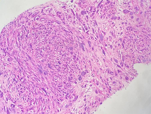 Microscopic examination shows fibro-fatty tissue infiltrated by a sarcomatous proliferation made up of long bundles of spindle-shaped cells of high cellular density. These cells have elongated, hyperchromatic nuclei with nuclear pleomorphism.