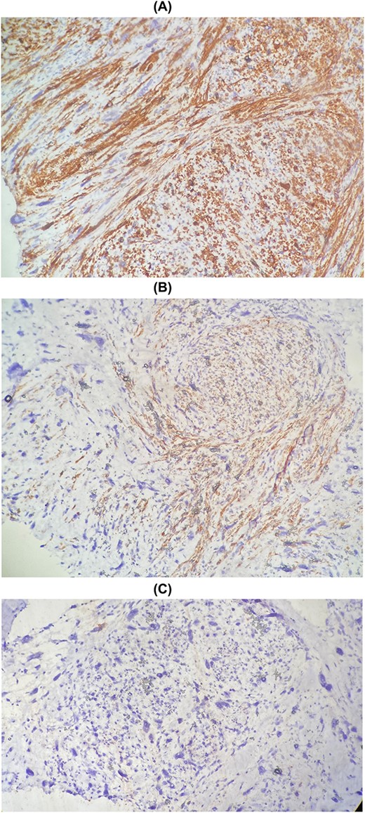 Immunohistochemical staining showing positive expression of H-caldesmon (A) and Desmin (B) negative expression of CKAE1/AE3 (C).