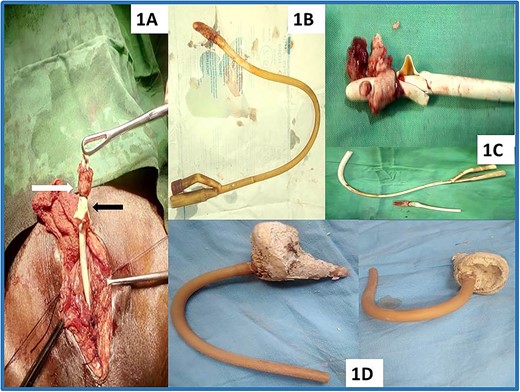 Vesical calculi from the prolonged and neglected indwelling vesical catheter; the associated stone burden vis-a-vis the duration of neglected indwelling bladder catheter can be seen at 3 months (B), 6 months (C) and 10 months (D). (A) Cystolithotomy image showing the stone (white arrow) and the ruptured balloon (Black arrow) as evidence of failed attempt at removal of retained urethral catheter from a secondary referring facility. (B) Suprapubic cystostomy catheter removed after local lidocaine infiltration adjacent to the cystostomy site. Panel (C) is the catheter with associated stone and fragments of the patient in (A). Panels (C) and (D) are retained urethral catheters with vesical calculi cut distally to enable removal through cystolithotomy wound. The stones volume in (C) and (D) are (4 cm × 3 cm) and (8 cm × 6 cm), respectively.