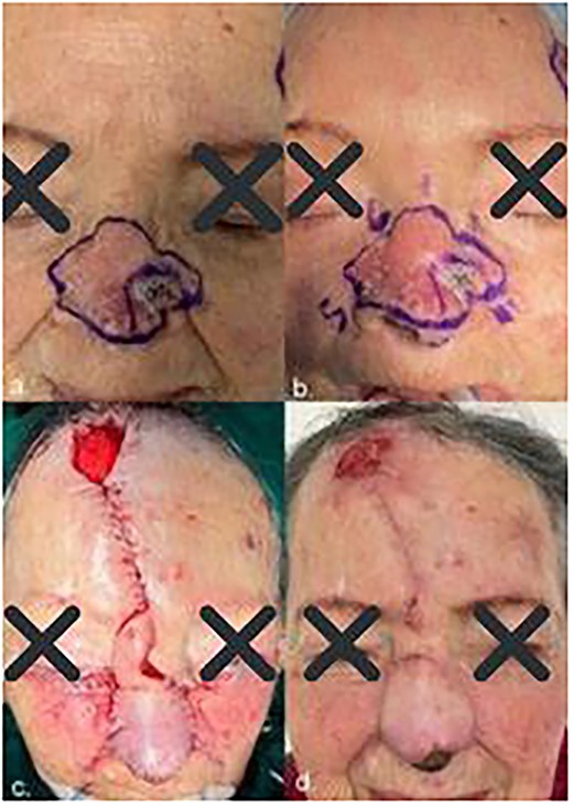 (a) Initial lesion; (b) clockwise order lesion; (c) immediate post-operative result and (d) follow-up after 4 weeks showed excellent functional and cosmetic results.