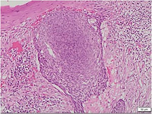 Microscopic view of the BCC, nodular type: note the large nest of basaloid cells centered in the dermis with cleft retraction, peripheral palisading, mitotic activity and cytological atypia.