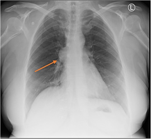 Chest X-ray showing anterior BMC (arrow).