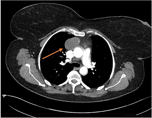 Transverse CT thorax showing anterior BMC (arrow).