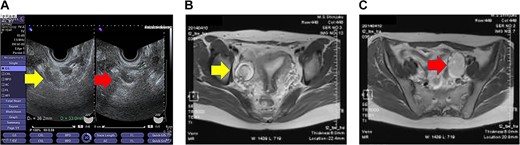 Imaging studies of the pelvis. (A) Transvaginal ultrasound image showing a right ovarian cyst (left arrow) and a left ovarian cyst (right arrow). (B) Axial T2-weighted MRI showing a right ovarian cyst (arrow). (C) Axial T2-weighted MRI showing a left ovarian cyst (arrow).