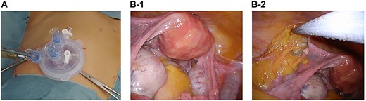 Laparoscopic views and pathological findings. (A) Single-port system for laparoscopic viewing: Lap Disc Mini® (Hakko Corporation, Osaka, Japan) and EZ Access® (Hakko Corporation). (B-1) The uterus, which is normal-sized, and the ovaries, which are swollen because of the presence of teratomas. (B-2) Omental tumor, resembling a teratoma.
