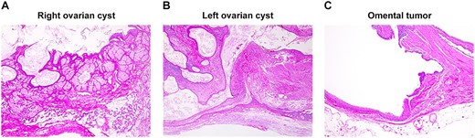 Pathological findings: right ovarian cyst (A), left ovarian cyst (B) and tumor in the greater omentum (C). (A, B) Ectodermal derivatives including the central nervous tissue and mesodermal derivatives including cartilage and adipose tissue in the ovarian tumor. (C) Ectodermal derivatives including squamous epithelium, respiratory epithelium and goblet cells were observed in the omental tumor.