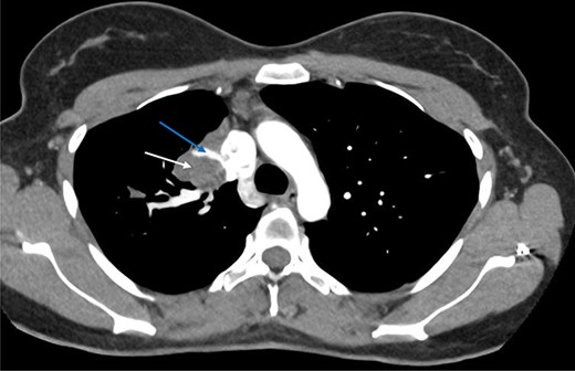 Axial arterial phase CT scan demonstrating pulmonary sequestration (bottom arrow). A large venous branch draining into the azygous vein can be identified (top arrow).