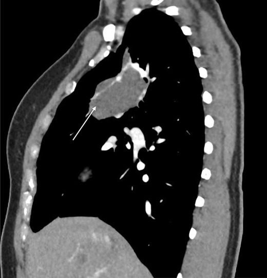 Sagittal CT scan demonstrating pulmonary sequestration in the right upper lung lobe (arrow).