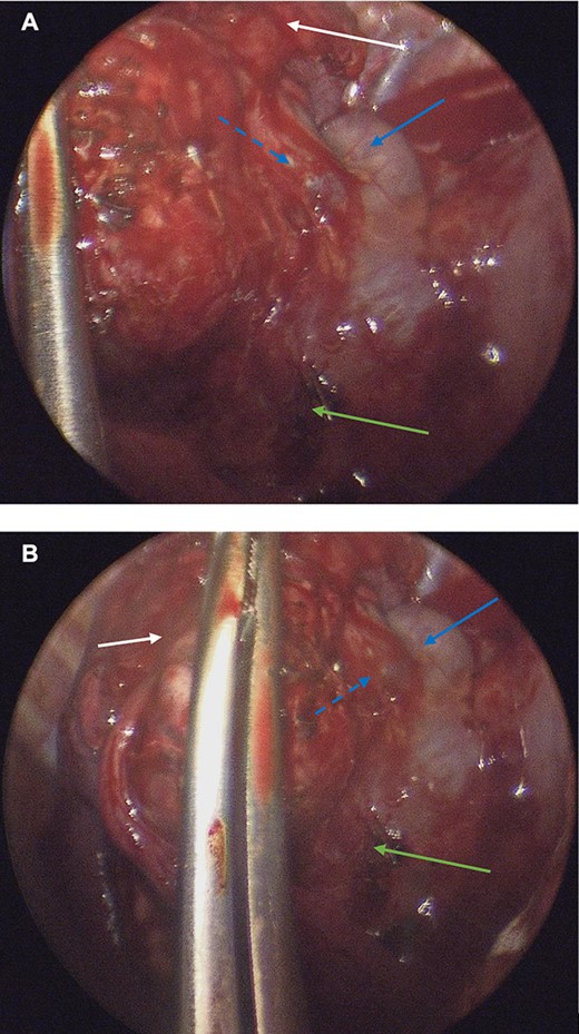 (A, B): Intraoperative thoracoscopic images demonstrating pulmonary sequestration (top arrow). A venous branch (middle punctuated arrow) of the azygous vein (middle solid arrow) may be appreciated. A surgical clip was placed on a systemic feeding artery (lowest arrow).