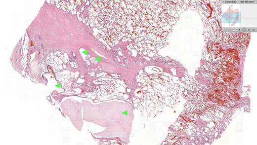 Histology image of the resected pulmonary section. Dilated bronchial spaces with mucous impaction can be identified (arrows).