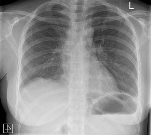 Anteroposterior post-operative chest radiograph.