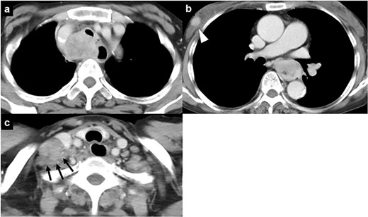 Chest computed tomography of a 59-year-old woman who was admitted to our hospital; (a) a mass is visible invading the trachea in the upper mediastinum; (b) an esophageal mass and a mass in the subcutaneous tissue of the right chest wall (arrowhead) are visible; (c) a mass in the right cervical region is also present (black arrows).
