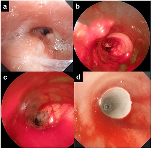 Rigid bronchoscopic findings: (a) the trachea is narrowed and has been invaded by the upper mediastinal mass; (b) perforation of the lower trachea is visible; (c) lung tissue is visible from the trachea; (d) a silicon Y-stent was inserted to cover the tracheal fistula.