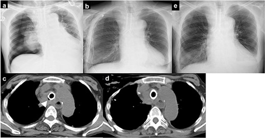 (a) chest X-ray showing right pneumothorax; (b) chest drainage was performed; (c) chest computed tomography immediately after surgery showing an air space on the right side of the stent; (d) the air space on the right side of the stent gradually disappeared; (e) chest X-ray showing no recurrence of pneumothorax.