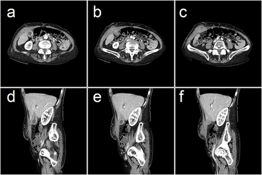 Representative CT images showing (a–c) axial and (d–f) sagittal views of a 47 × 23 × 66 mm complex collection within the right anterior abdominal wall, consisting of fluid and phlegmonous components. This collection is contiguous with a thick-walled gallbladder that contains calculi. These findings are consistent with an abdominal wall abscess complicating acute-on-chronic cholecystitis with extraperitoneal perforation.
