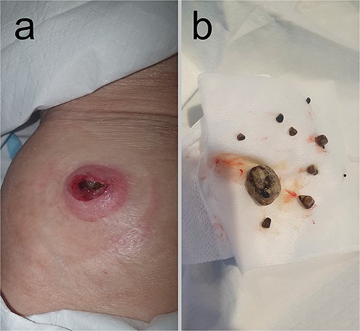 Clinical pictures taken at the time of representation 10 weeks following initial presentation and percutaneous drainage. (a) External opening of the CCF onto the skin of the right hypochondrium following removal of the obstructing gallstone from its orifice. (b) This obstructing 20 mm gallstone and multiple other gallstones, ranging in size from 2 to 7 mm, were retrieved from within the fistula tract.
