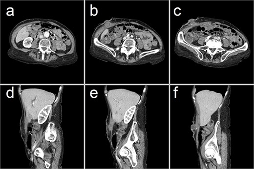 Representative CT images showing (a–c) axial and (d–f) sagittal views of the CCF, forming a communicating tract that extends from the gallbladder fundus, through the anterior abdominal wall and onto the skin. There has been interval collapse of the gallbladder, whose wall remains thickened with mucosal hyperenhancement, in keeping with chronic cholecystitis. Hyperenhancing gallstones are visible along this fistula tract.
