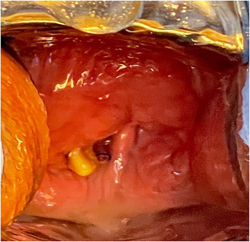 A vaginoscopy showed calcified stitches along with stone.