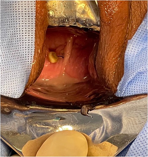 A vaginoscopy showed calcified stitches along with stone.