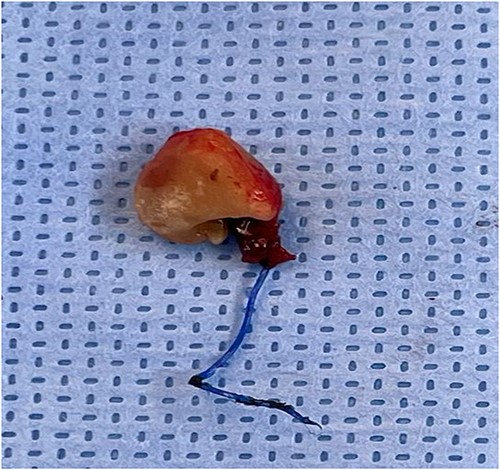 The stone and the stitches after removal.