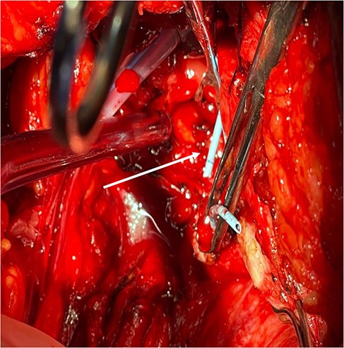 Fistula tract is cannulated with a guidewire as pointed in the arrow.