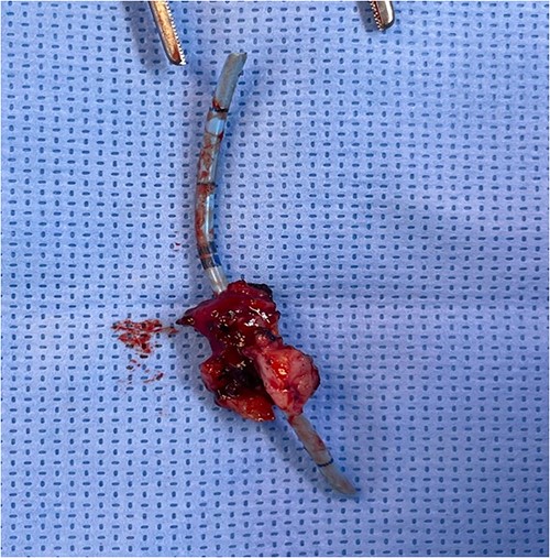 Fistula tract after complete excision.