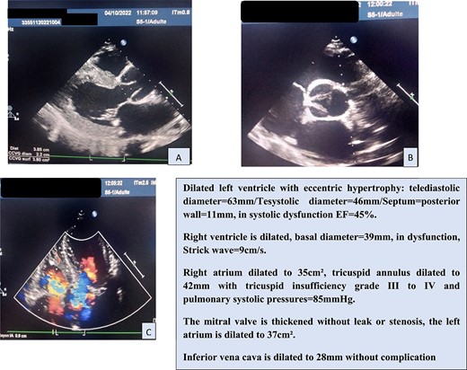 (A–C) Transthoracic echocardiogrphy sections.