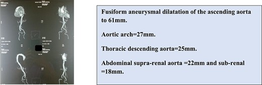 Thoracic angioscanner showing.