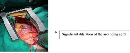 Cardiac structures after sternotomy.
