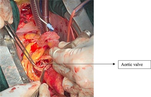 Aortic valve after resection of the supra-coronary aorta.