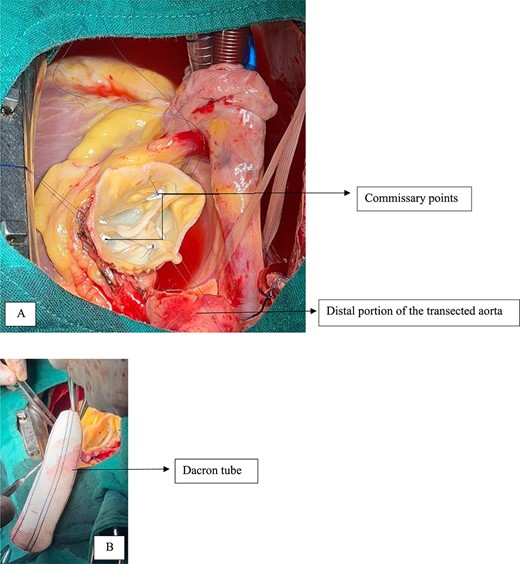 Commissural points at the three commissures, disappearance of the central diastasis.