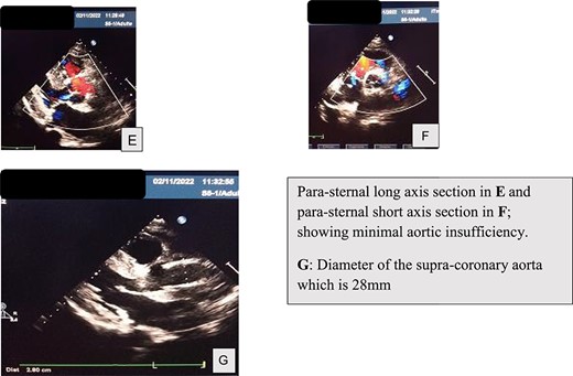 Postoperative TTE findings.