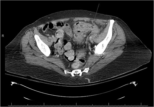 A fistulous connection from the sigmoid colon to the ovary is suggested. A dotted line arrow points out the connection.