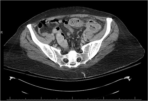 There is a thick-walled enhancing, 3.9 × 4.3 × 4.2 cm3 perisigmoidal collection containing nondependent gas and fluid with adjacent inflammatory fat stranding, suggestive of tubo-ovarian abscess.