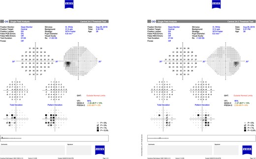 Humphrey 24–2 visual field illustrating enlarged blind spots with evidence of early superonasal loss bilaterally.