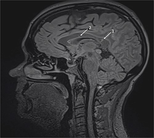 Brain magnetic resonance imaging (MRI) with sagittal T2 FLAIR illustrating linear ‘spoke’ (1) and T2 hyperintense lesions (2) in the corpus callosum.