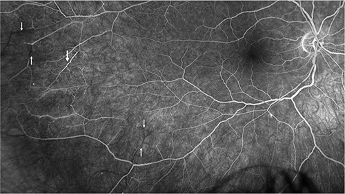 Fluorescein angiography of the right eye illustrating pathognomonic findings of BRAOs (thin arrows) and AWH (thick arrow).