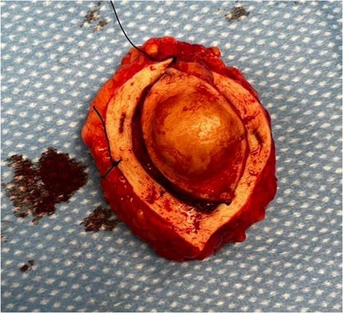 Image of the abdominal DFSP.