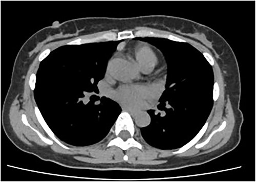 Chest CT showing a well-circumscribed tumor shadow of 15 mm in the anterior mediastinum.