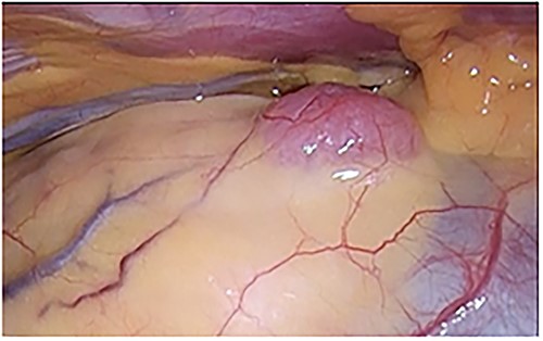 A pale red tumor covered with pleura at the edge of the right lower pole of the thymus.