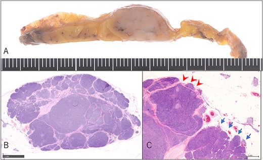 Pathological findings. (A) Macroscopic findings of the resected specimen: lobular whitish tumor below the pleura. (B) Microscopic findings of the resected specimen on hematoxylin–eosin staining. Type B1 thymoma detected just above the pleura without entire fibrous capsule formation (magnification: bar = 2.5 mm). (C) Short fibrous band at the edge of the tumor (arrow-head), whereas invasion of the surrounding thymus lacked fibrous capsule (arrow) (magnification: bar = 1 mm).