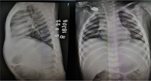 X-ray dorsal spine anteroposterior and lateral views, showing no significant abnormality.